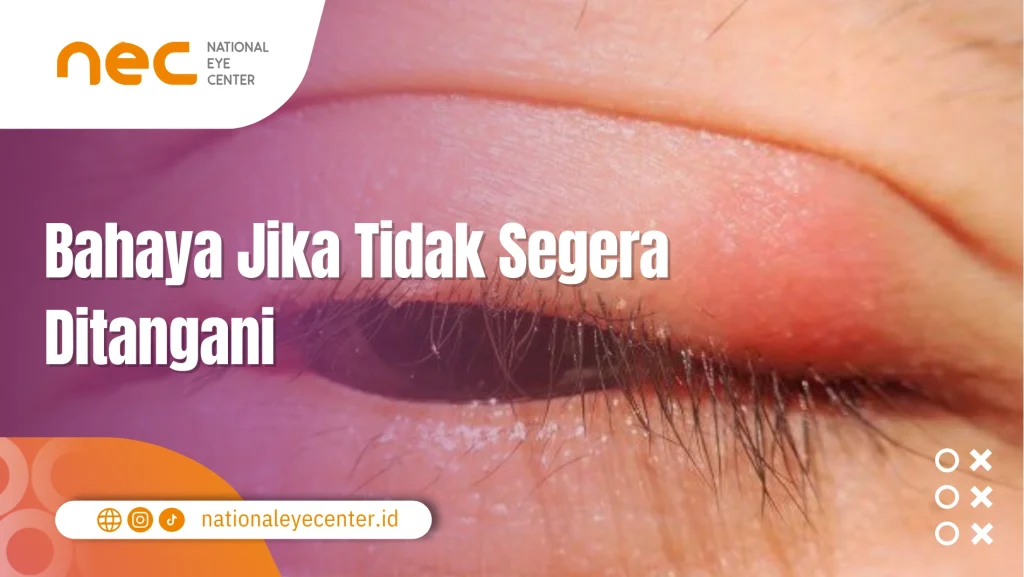 mata Terkena getah kaktus