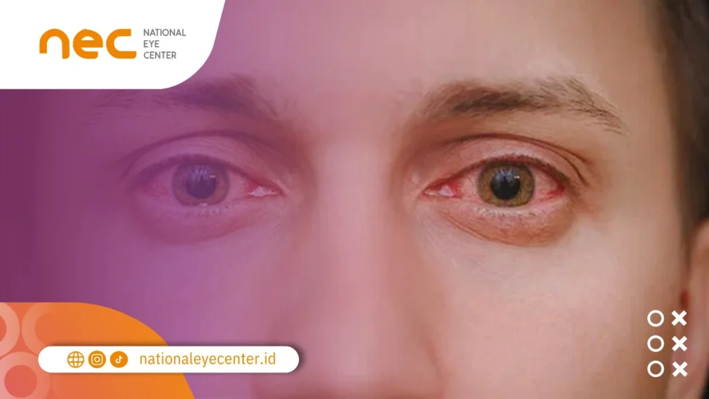 Apa Saja Gejala Autoimun Mata?