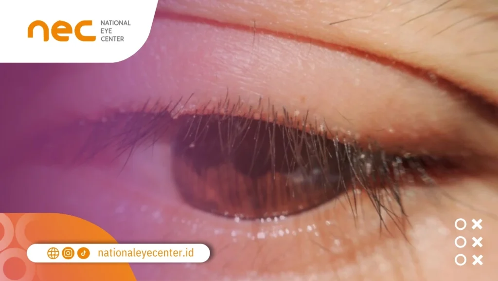 Penyebab Bulu Mata Masuk ke Mata