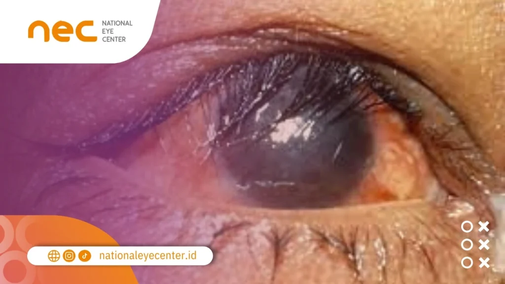 Apa yang Harus Dilakukan Jika Bulu Mata Masuk ke Mata?