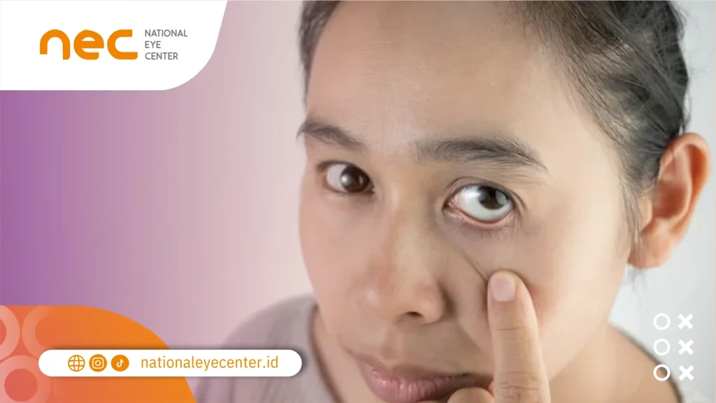 Apa itu Koloboma di Mata?