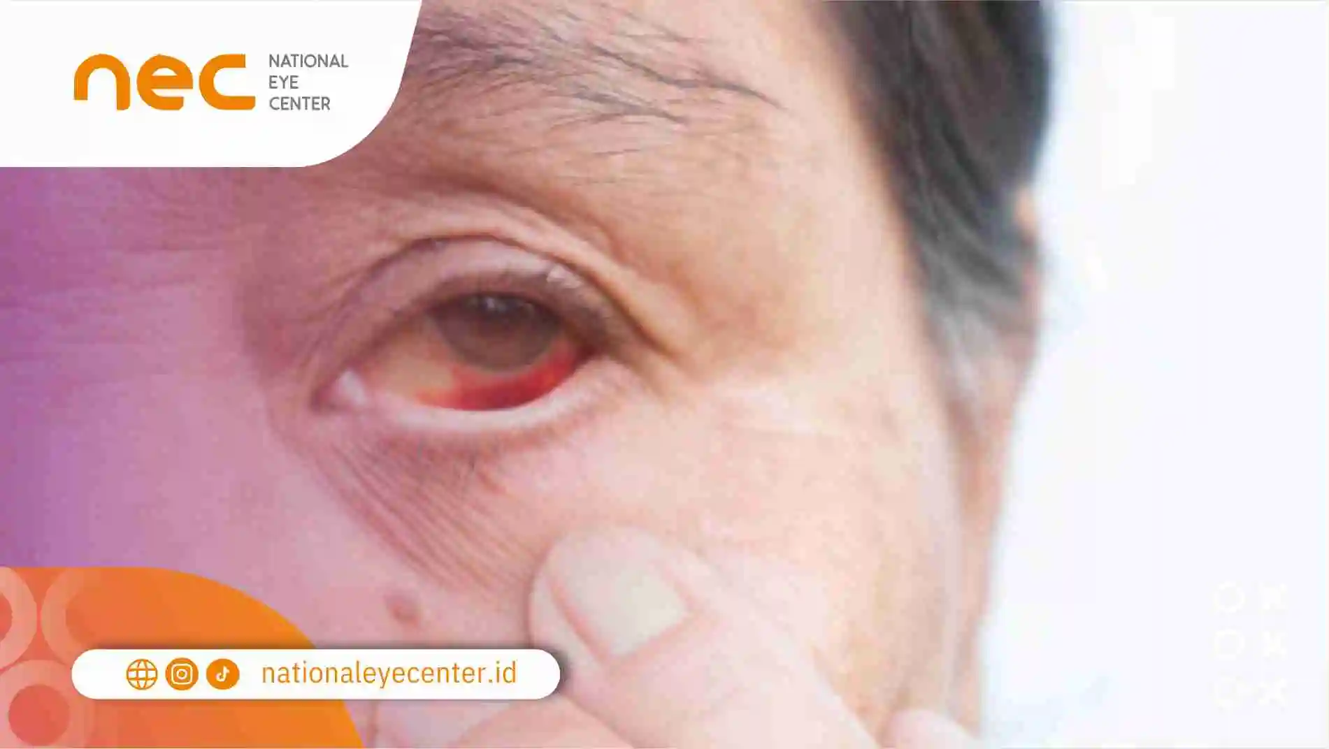 Apa penyebab dari limfoma?