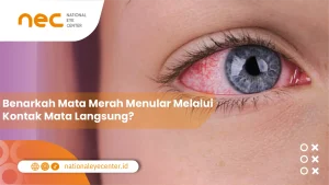 Benarkah Mata Merah Menular Melalui Kontak Mata Langsung?