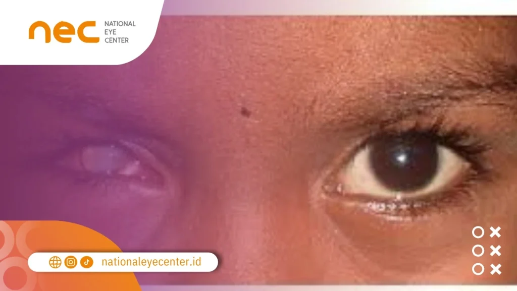 Gejala dari Phthisis Bulbi