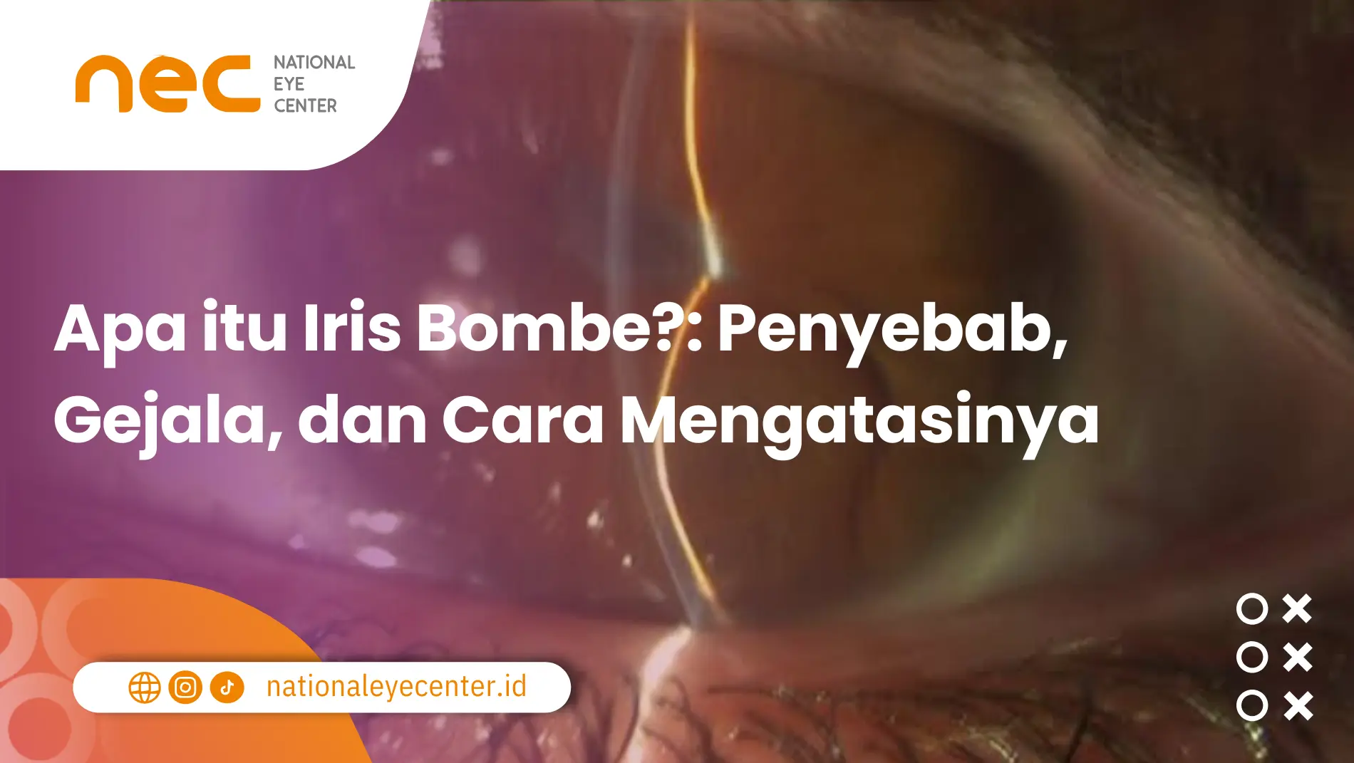 Iris Bombe adalah