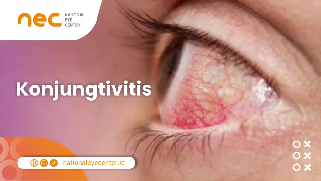 Konjungtivitis (mata merah)