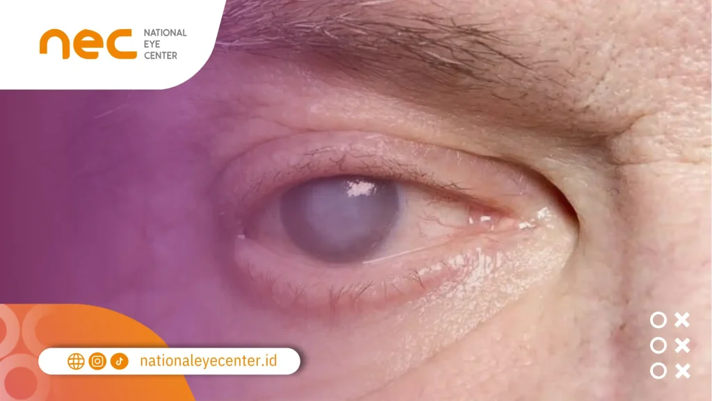 Apakah Warna Mata bisa Berubah? Ini Penjelasannya warna mata berubah