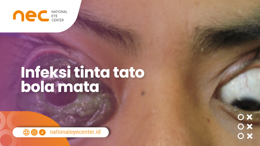 Reaksi alergi terhadap tinta tato