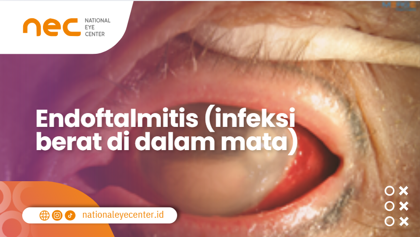 Endoftalmitis (infeksi berat di dalam mata)