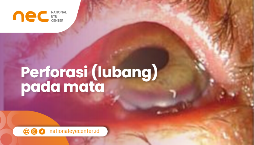 Perforasi (lubang) pada mata