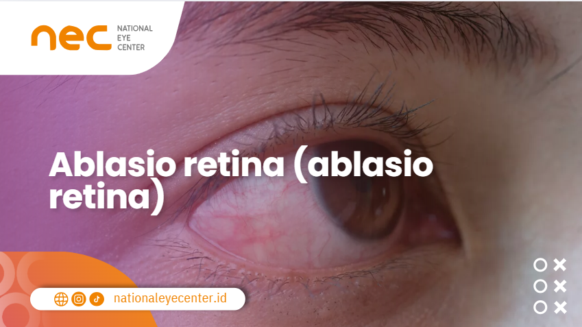 Ablasio retina (ablasio retina)