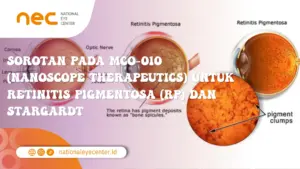 Sorotan pada MCO-010 (Nanoscope Therapeutics) untuk Retinitis Pigmentosa (RP) dan Stargardt
