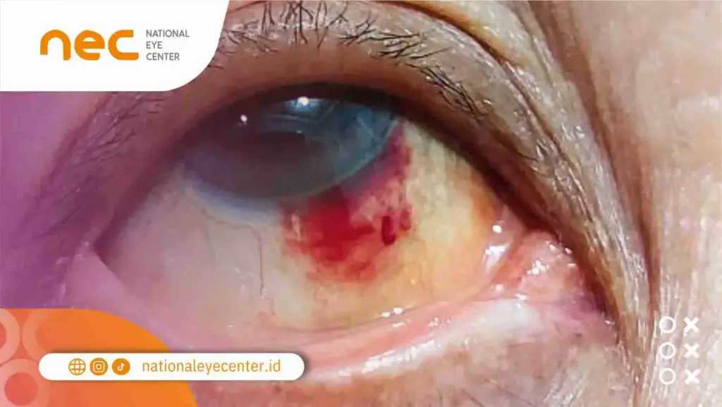 Perbedaan Hifema Dan Perdarahan Subkonjungtiva