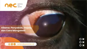 Hifema: Penyebab, Gejala, dan Cara Mengobati