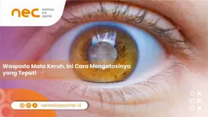 Waspada Mata Keruh, Ini Cara Mengatasinya yang Tepat!