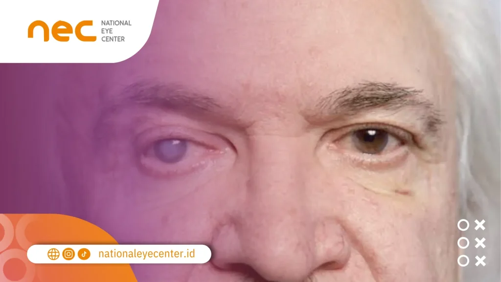 glaukoma dan gangguan tidur