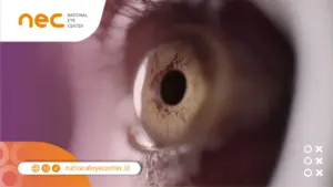 Anatomi dan Struktur Unik Lensa Mata