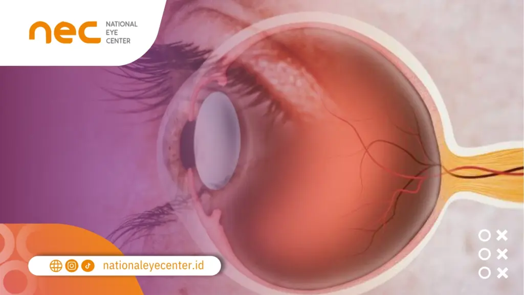 angkat beban meningkatkan tekanan mata