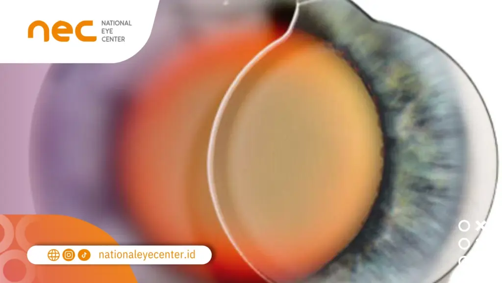 cara sembuhkan katarak