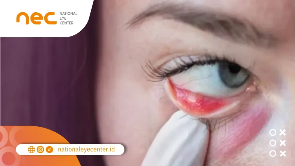 penyebab mata bintitan