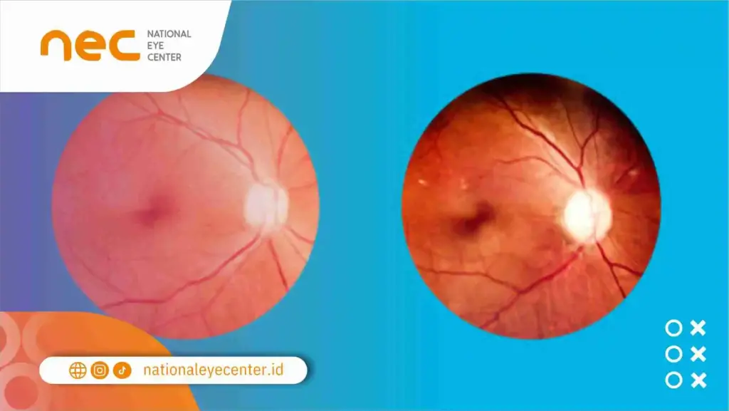 Penyakit yang Dapat Terjadi di Saraf Mata